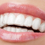 ortodoncia invisible - Clinica dental Valdemoro